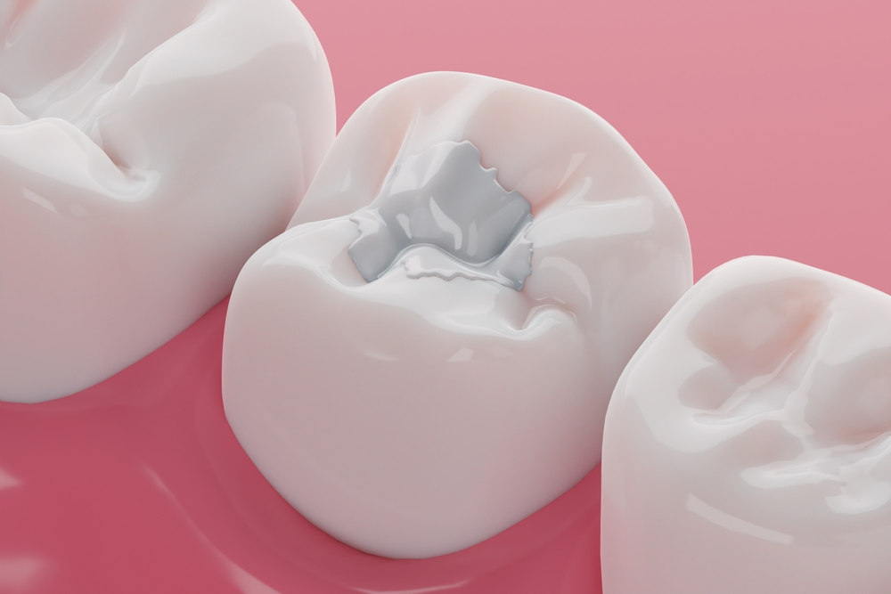 Illustration 3D d'une dent avec plombage en amalgame avant remplacement par une résine composite